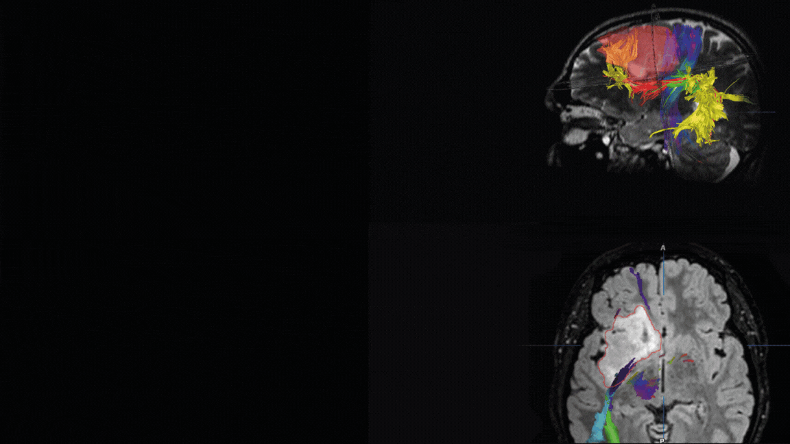 8th Mapping Course: Neurosurgery Course Bellvitge 2025