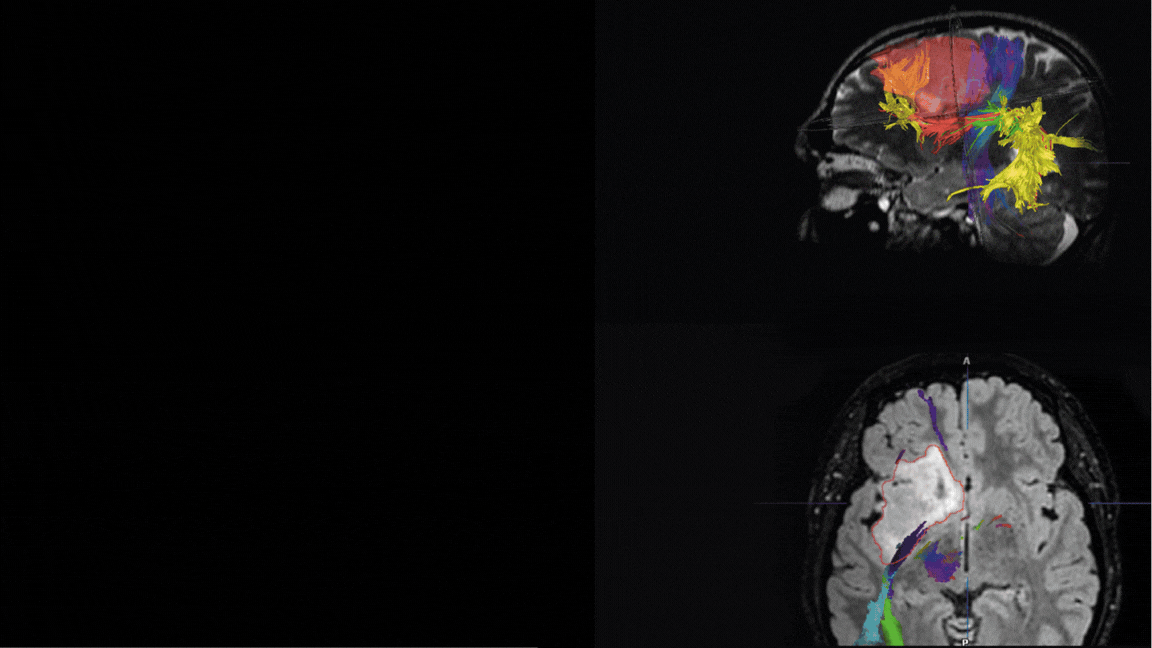 9th Mapping Course: Neurosurgery Course Bellvitge 2026