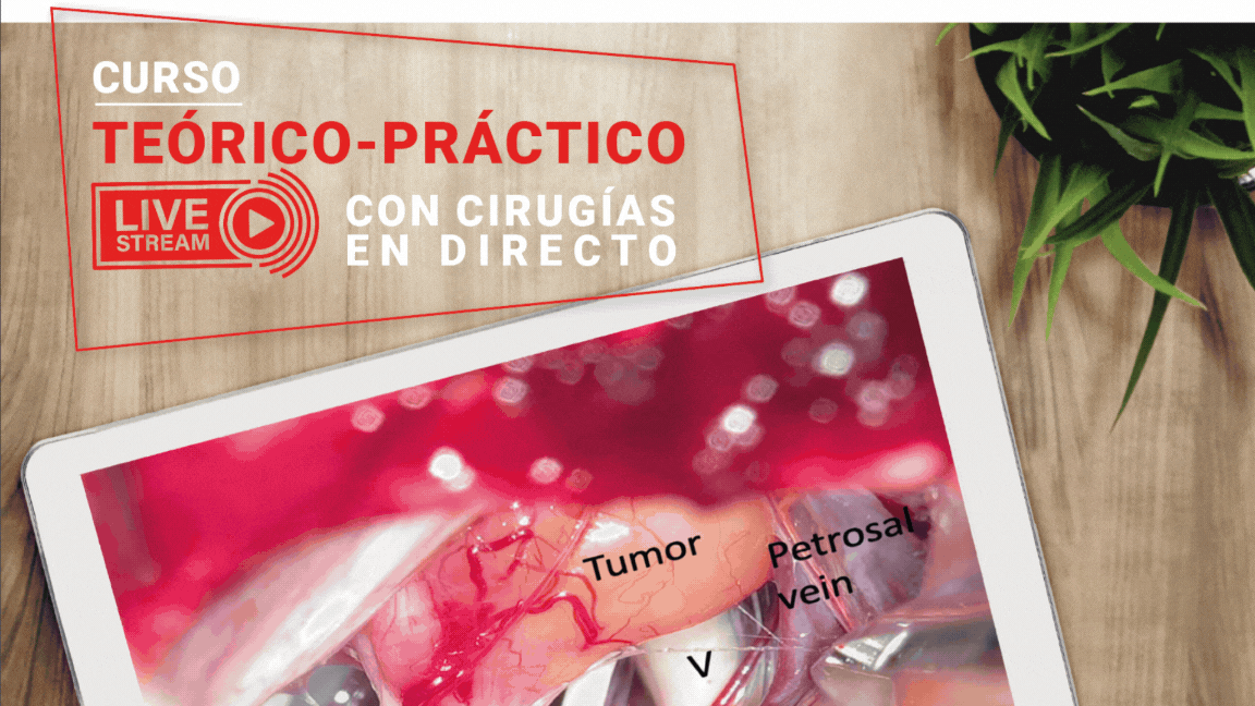 Actualización en el tratamiento quirúrgico del Schwannoma vestibular